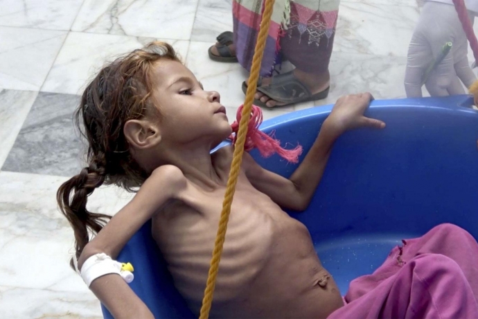 Yemen'de Yaklaşık 85 Bin Çocuk Yetersiz Beslenmeden Ölmüş Olabilir 